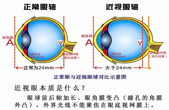 近视本质