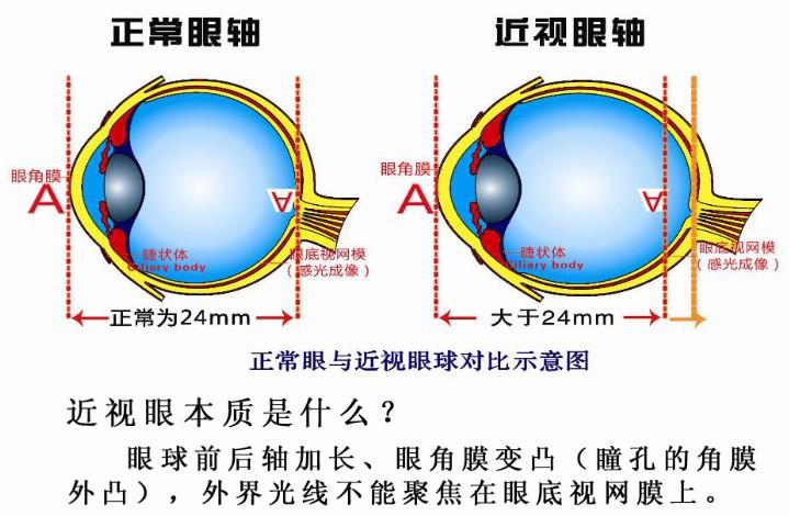 近视本质