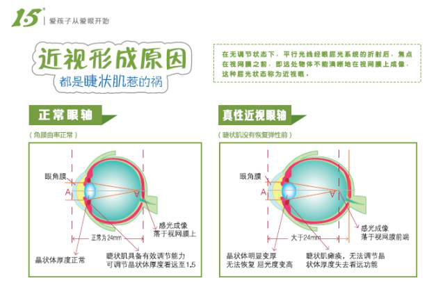 眼于特殊行为研究时,发现每周读书时间或使用电脑时间都不是导致近视