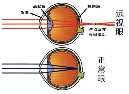 近视,远视,散光,都是因为这个原因!